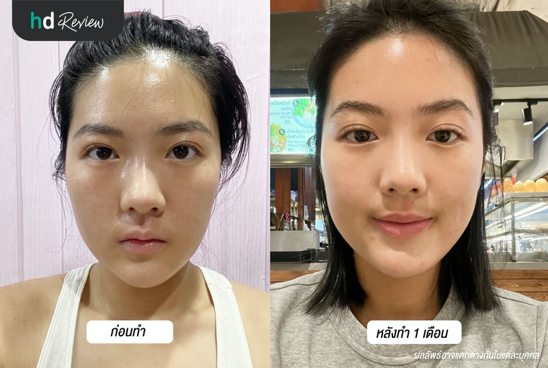 Before After ฉีดแฟต SiSi Premium ที่ Ssense Clinic By Dr.Veeravit