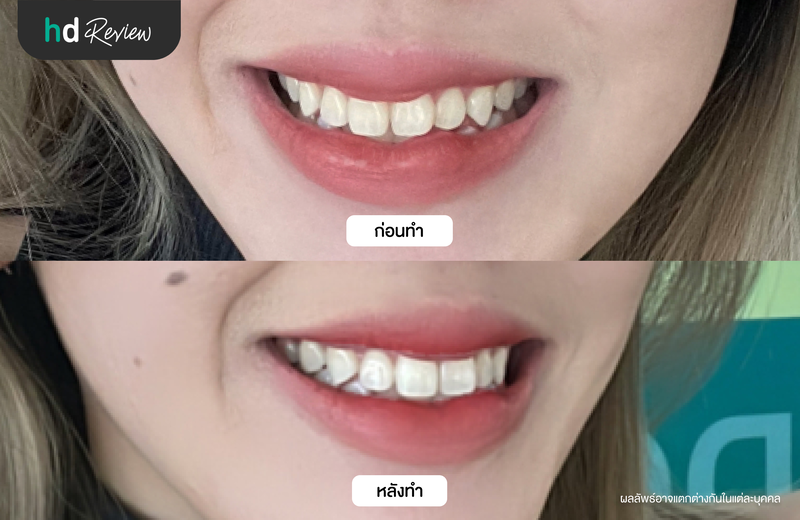 ภาพเปรียบเทียบผลลัพธ์ก่อนและหลังฟอกสีฟันแบบ Zoom