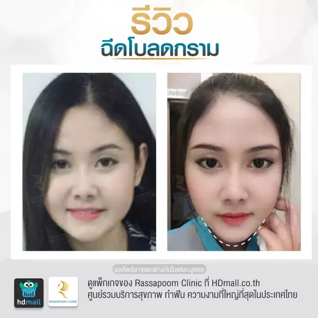 Before After ฉีดโบท็อกซ์ลดกราม ที่ Rassapoom Clinic รูปที่ 1