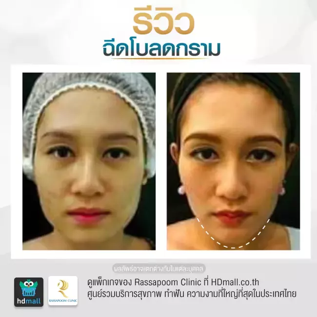 Before After ฉีดโบท็อกซ์ลดกราม ที่ Rassapoom Clinic รูปที่ 2