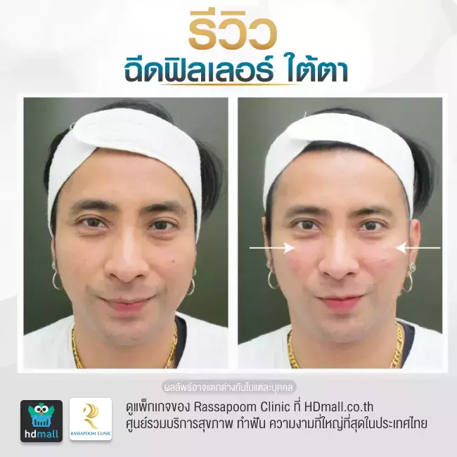 Before After ฉีดฟิลเลอร์ใต้ตา ที่ Rassapoom Clinic รูปที่ 1