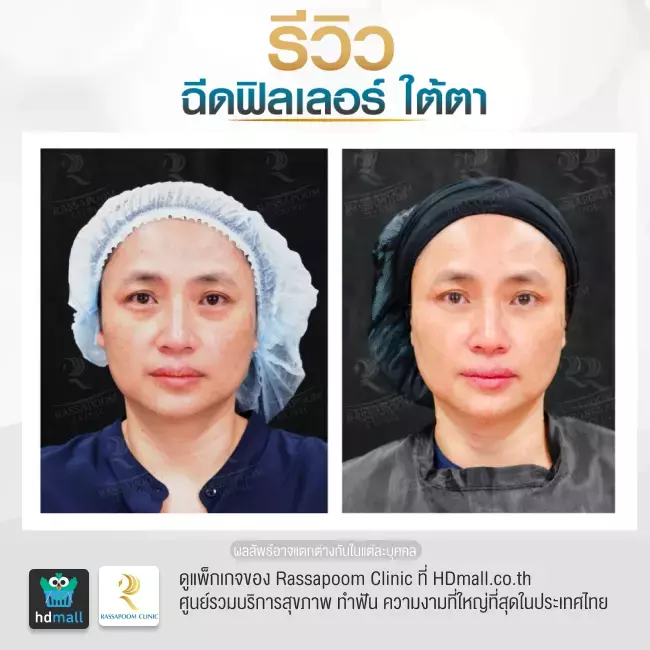 Before After ฉีดฟิลเลอร์ใต้ตา ที่ Rassapoom Clinic รูปที่ 2