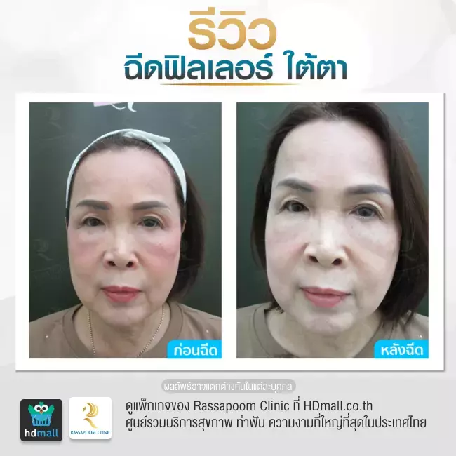 Before After ฉีดฟิลเลอร์ใต้ตา ที่ Rassapoom Clinic รูปที่ 3