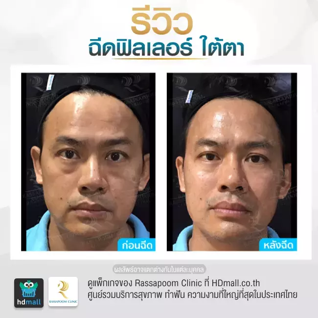 Before After ฉีดฟิลเลอร์ใต้ตา ที่ Rassapoom Clinic รูปที่ 4