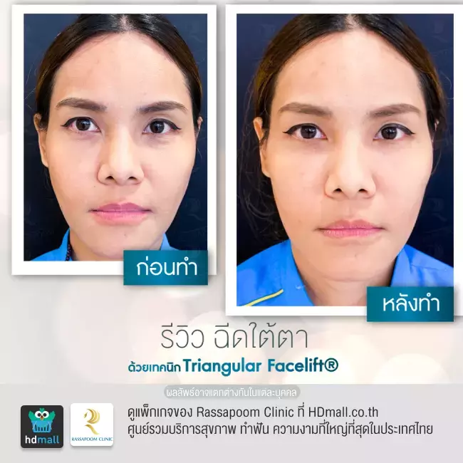 Before After ฉีดฟิลเลอร์ใต้ตา ที่ Rassapoom Clinic รูปที่ 5