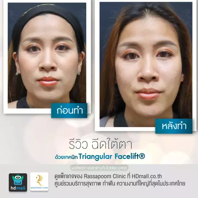 Before After ฉีดฟิลเลอร์ใต้ตา ที่ Rassapoom Clinic รูปที่ 6