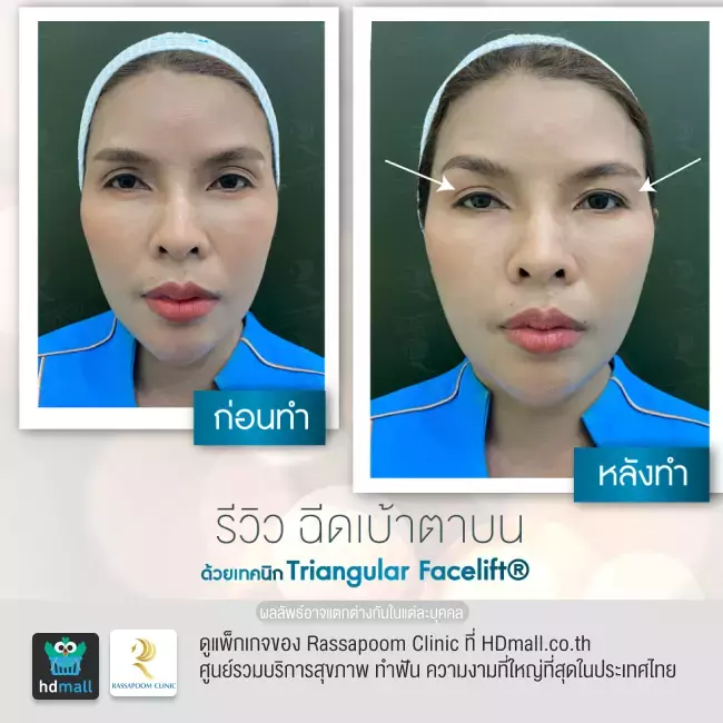 Before After ฉีดฟิลเลอร์เบ้าตาบน ที่ Rassapoom Clinic รูปที่ 1