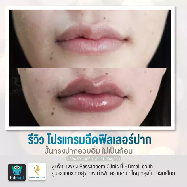 Before After ฉีดฟิลเลอร์ปาก ที่ Rassapoom Clinic รูปที่ 1