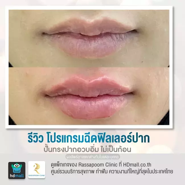 Before After ฉีดฟิลเลอร์ปาก ที่ Rassapoom Clinic รูปที่ 2