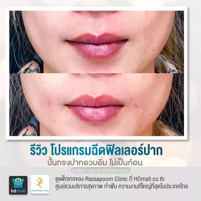 Before After ฉีดฟิลเลอร์ปาก ที่ Rassapoom Clinic รูปที่ 3