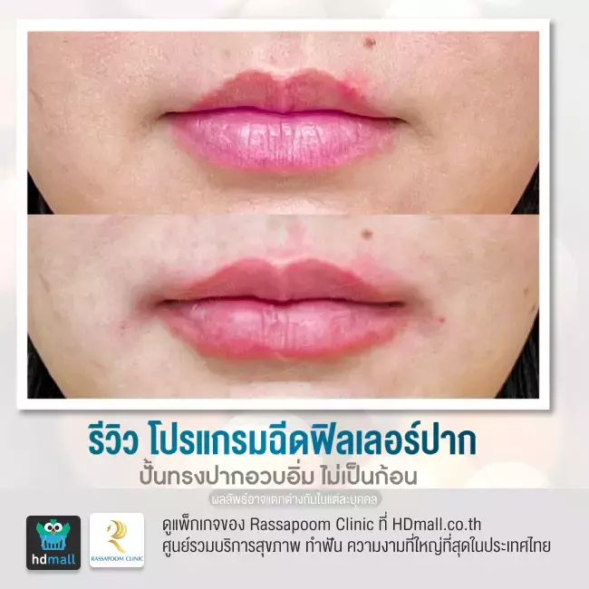 Before After ฉีดฟิลเลอร์ปาก ที่ Rassapoom Clinic รูปที่ 4