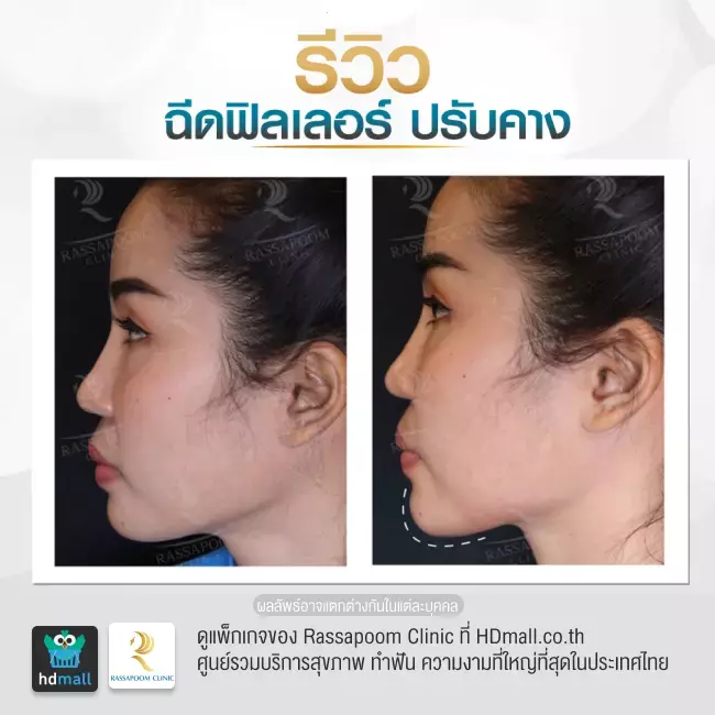 Before After ฉีดฟิลเลอร์คาง ที่ Rassapoom Clinic (รัสมิ์ภูมิคลินิก) รูปที่ 1