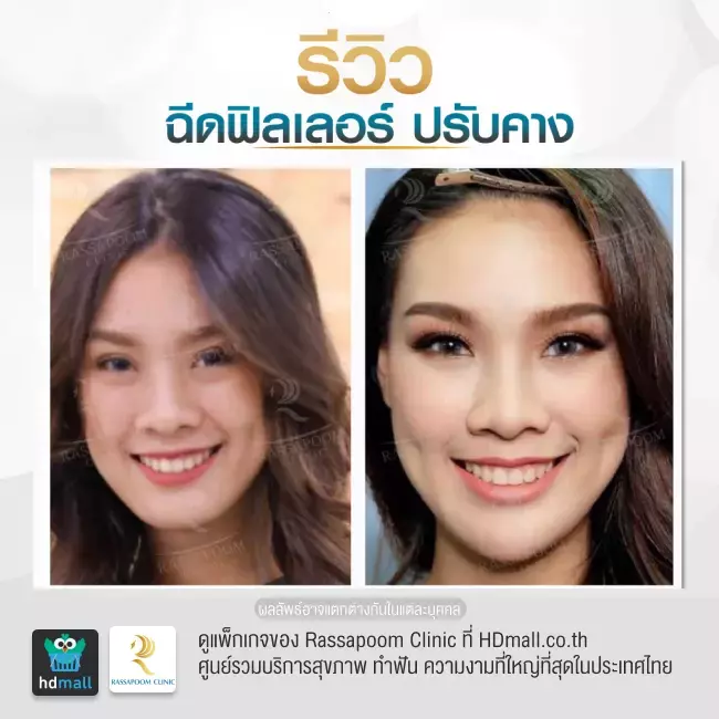 Before After ฉีดฟิลเลอร์คาง ที่ Rassapoom Clinic (รัสมิ์ภูมิคลินิก) รูปที่ 2