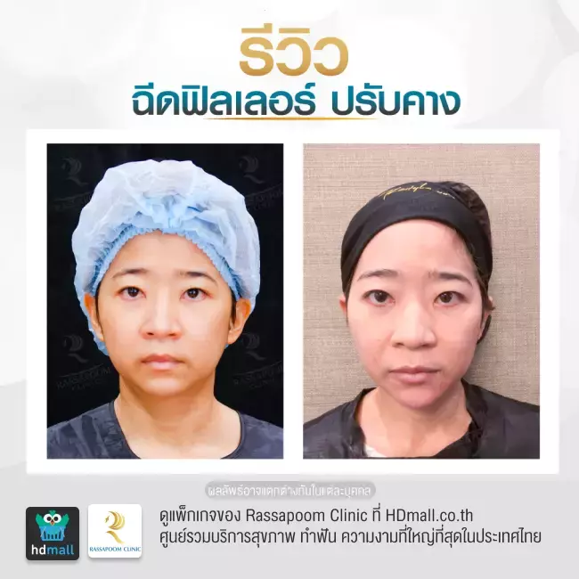 Before After ฉีดฟิลเลอร์คาง ที่ Rassapoom Clinic (รัสมิ์ภูมิคลินิก) รูปที่ 3