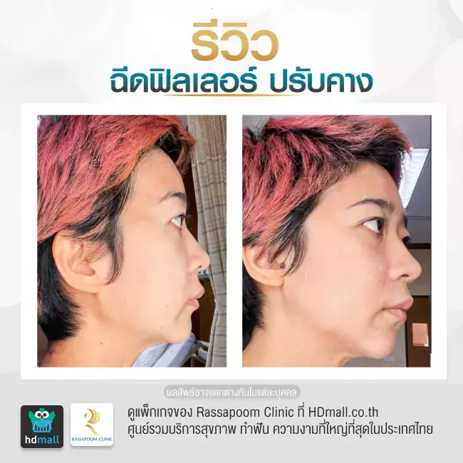 Before After ฉีดฟิลเลอร์คาง ที่ Rassapoom Clinic (รัสมิ์ภูมิคลินิก) รูปที่ 4