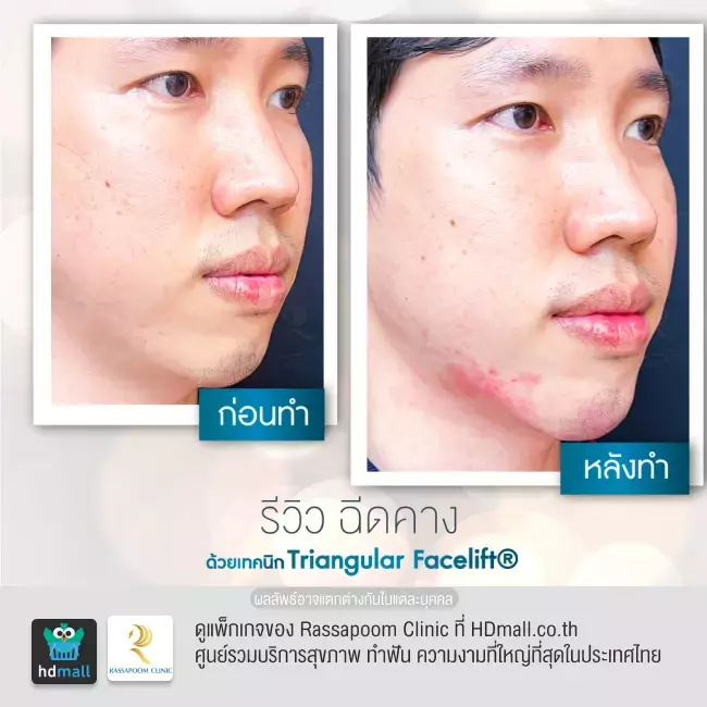 Before After ฉีดฟิลเลอร์คาง ที่ Rassapoom Clinic (รัสมิ์ภูมิคลินิก) รูปที่ 6