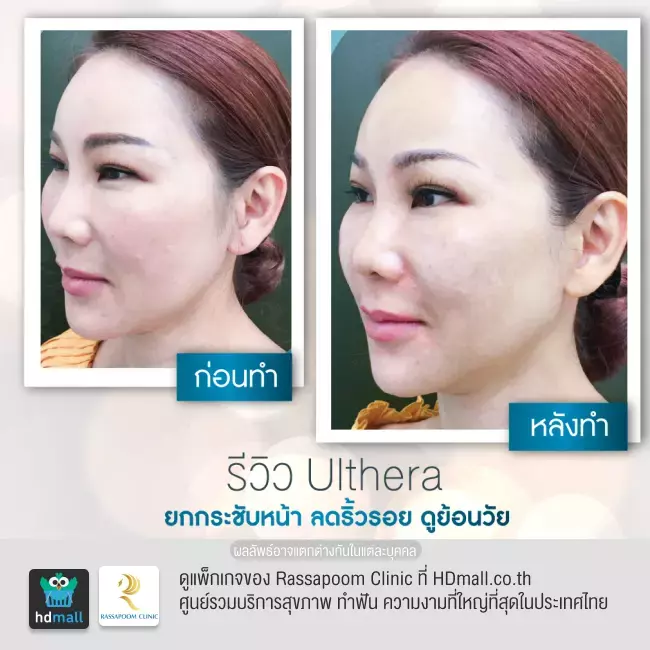 Before After ทำ Ulthera ยกกระชับหน้า เหนียง ที่ Rassapoom Clinic (รัสมิ์ภูมิคลินิก) รูปที่ 1