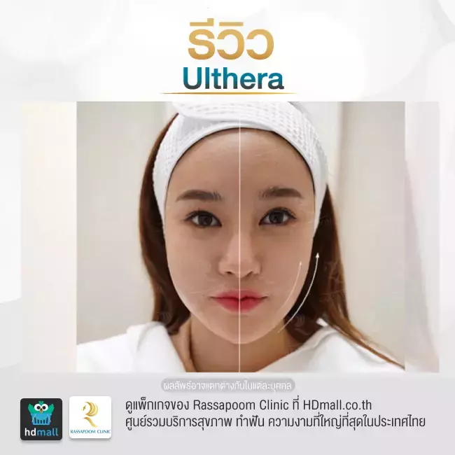 Before After ทำ Ulthera ยกกระชับหน้า เหนียง ที่ Rassapoom Clinic (รัสมิ์ภูมิคลินิก) รูปที่ 2