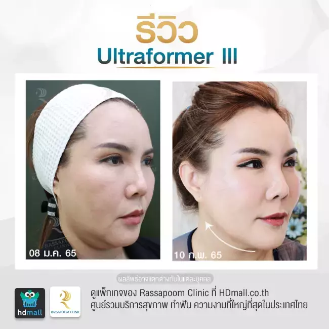 Before After ทำ Ultraformer III ที่ Rassapoom Clinic (รัสมิ์ภูมิคลินิก) รูปที่ 1