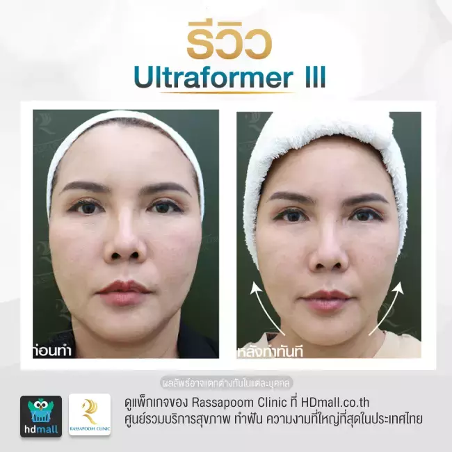 Before After ทำ Ultraformer III ที่ Rassapoom Clinic (รัสมิ์ภูมิคลินิก) รูปที่ 2