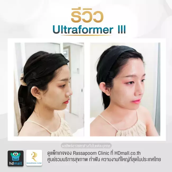 Before After ทำ Ultraformer III ที่ Rassapoom Clinic (รัสมิ์ภูมิคลินิก) รูปที่ 3