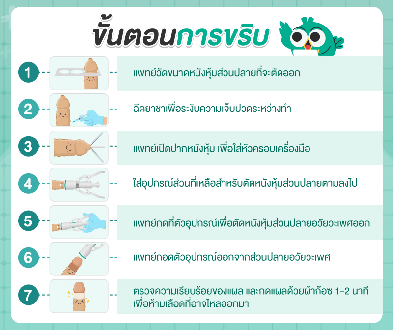 ขั้นตอนการขริบไร้เลือด