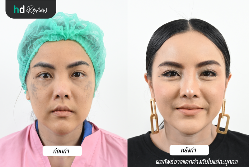 before after หน้าตรง Versac'e Clinic