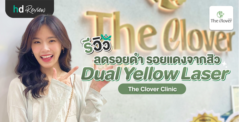 รีวิวโปรแกรม Dual Yellow Laser ลดรอยดำ รอยแดงจากสิว ที่ The Clover Clinic