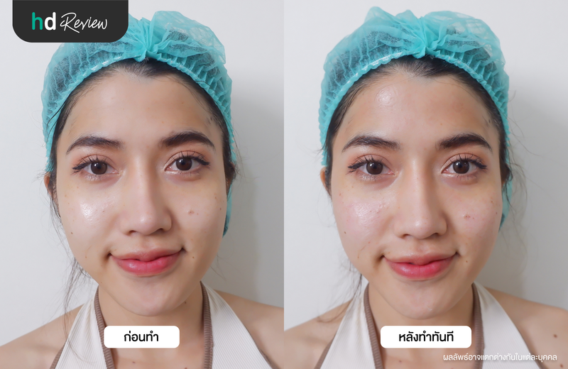 ผลลัพธ์หลังฉีด Skin Booster