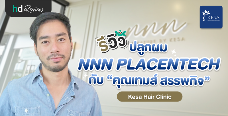 รีวิว ปลูกผม NNN PLACENTECH กับ “คุณเทมส์ สรรพกิจ”