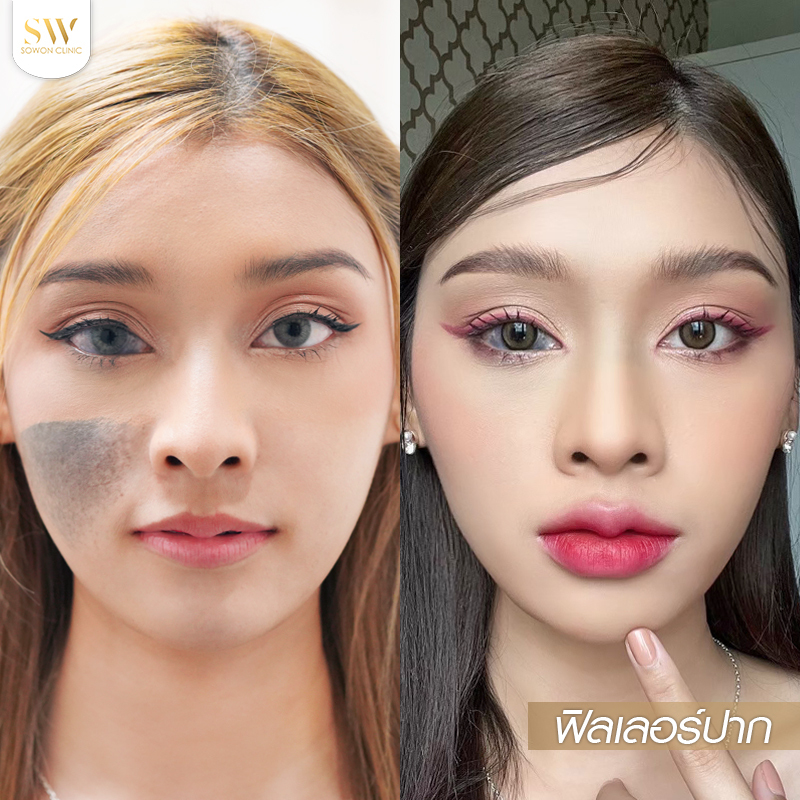 Before After ฉีดฟิลเลอร์ปาก ที่ Sowon Clinic