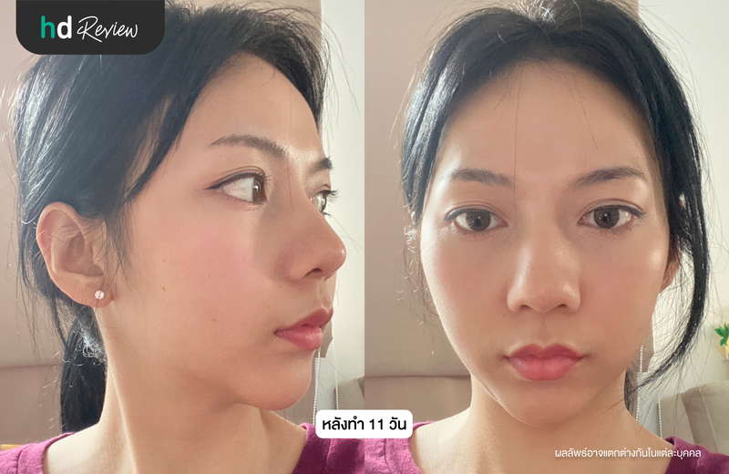 ผลลัพธ์หลังใช้บริการโปรแกรม Acne ดูแลปัญหาสิว ด้วย LED Light และ Yag Laser ที่ The Peaches Clinic