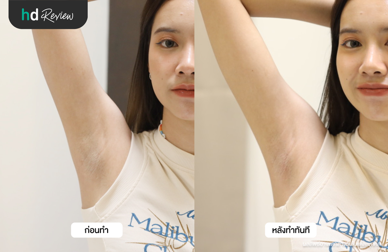 ภาพเปรียบเทียบก่อนและหลังเลเซอร์กำจัดขนรักแร้ทันที