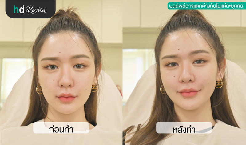 ผลลัพธ์หลังฉีดฟิลเลอร์ร่องแก้ม ที่ Kharis Clinic