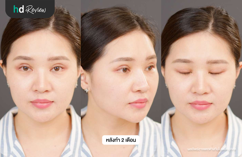 แก้ตาหอยแครง เทคนิค Eyes Reconstruction ที่ Dr.Vii Aesthetic Clinic