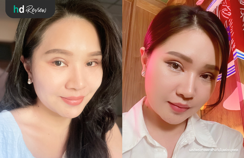 แก้ตาหอยแครง เทคนิค Eyes Reconstruction กับคุณหมอวิ ที่ Dr.Vii Aesthetic Clinic