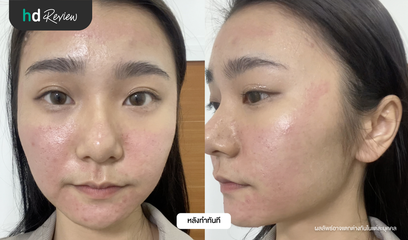 ผลลัพธ์หลังรักษาหลุมสิว ด้วยโปรแกรม Picosecond Laser ทันที