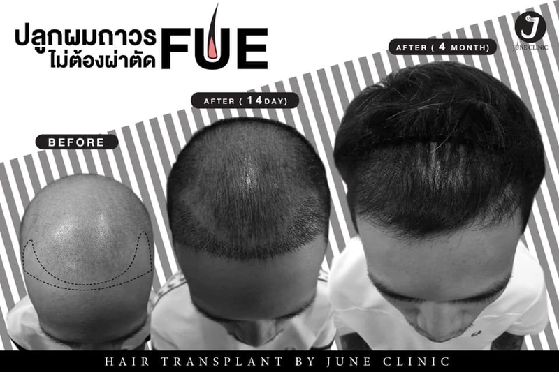 เปรียบเทียบก่อนและหลังปลูกผมที่ June Clinic