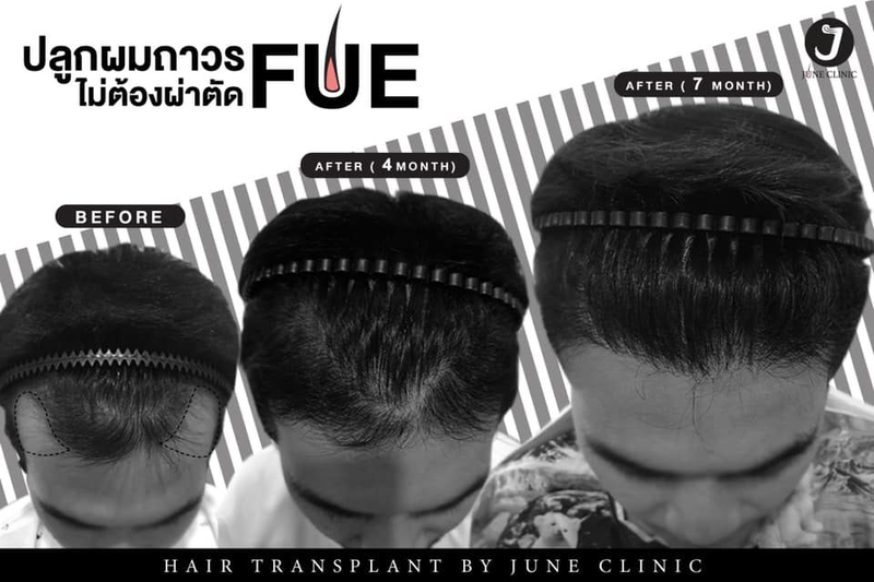 รีวิวปลูกผมที่ June Clinic