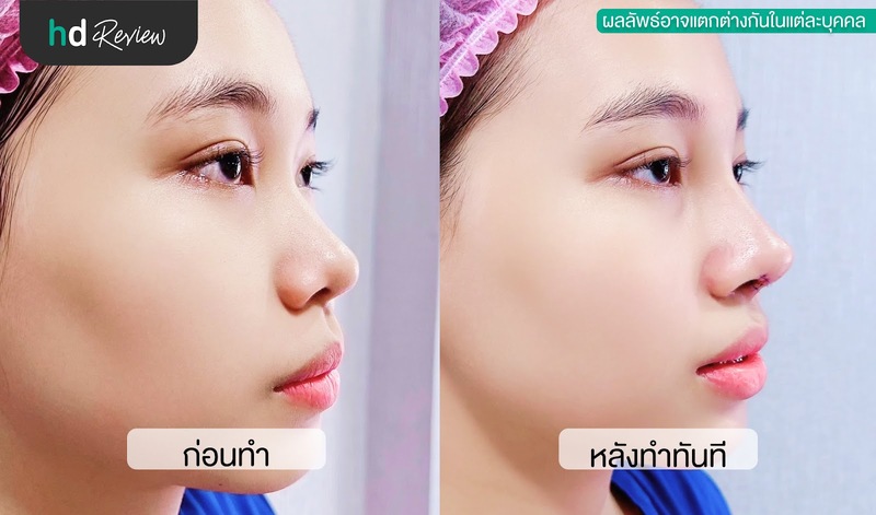 เปรียบเทียบก่อนและหลังทำจมูกที่ Hathaitip Clinic (หทัยทิพย์คลินิก)​