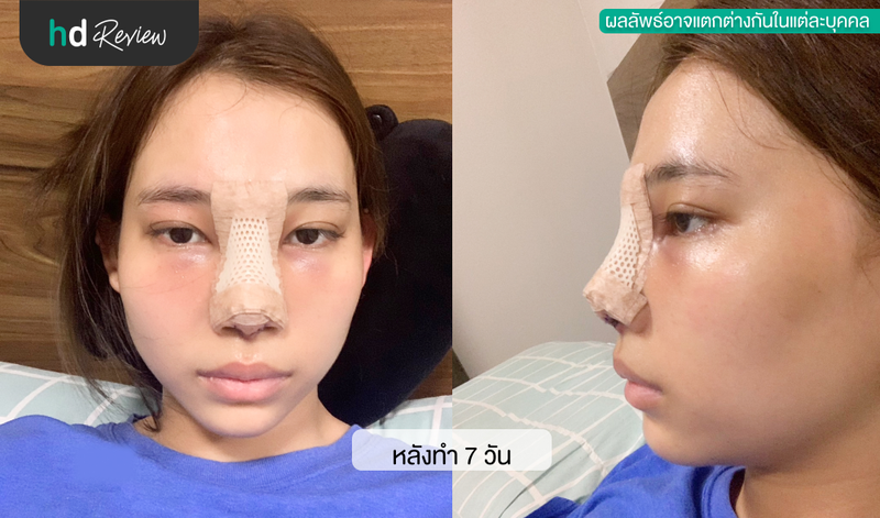 หลังทำจมูก 7 วันกับหมอวีที่ Hathaitip Clinic (หทัยทิพย์คลินิก)​