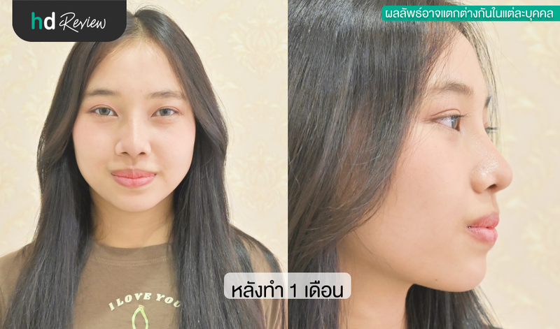 หลังทำจมูก 1 เดือนกับหมอวี ที่ Hathaitip Clinic (หทัยทิพย์คลินิก)​