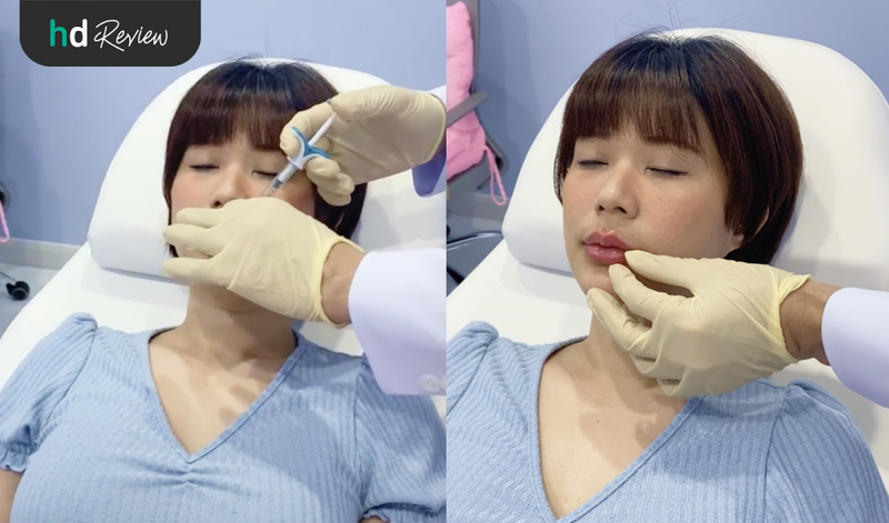 ระหว่างฉีดฟิลเลอร์ปาก Juvederm ที่ Jorin Jaroen Clinic