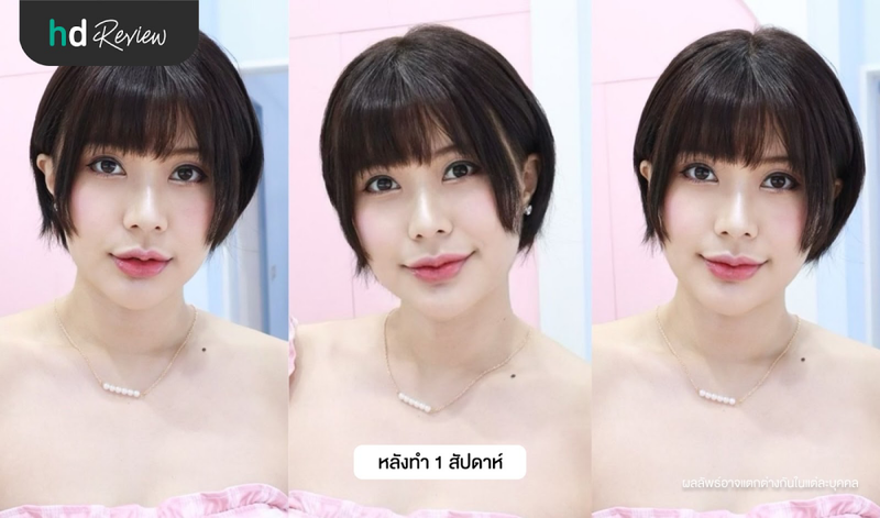 ฉีดฟิลเลอร์ปาก Juvederm ที่ Jorin Jaroen Clinic ดีจริงมั้ย