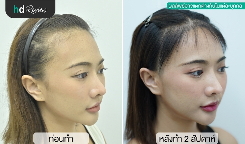 Before and After ปลูกผมเทคนิค Long Hair NNN ที่ Kesa Hair Clinic