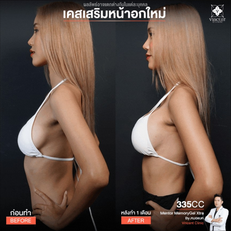 ก่อนและหลังเสริมหน้าอกที่ Vincent Clinic คนที่ 1 ด้านข้าง