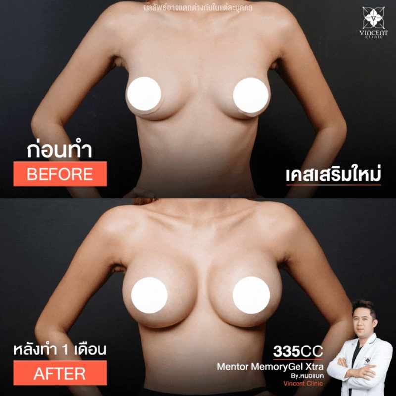 ก่อนและหลังเสริมหน้าอกที่ Vincent Clinic คนที่ 1 โชว์หน้าอก