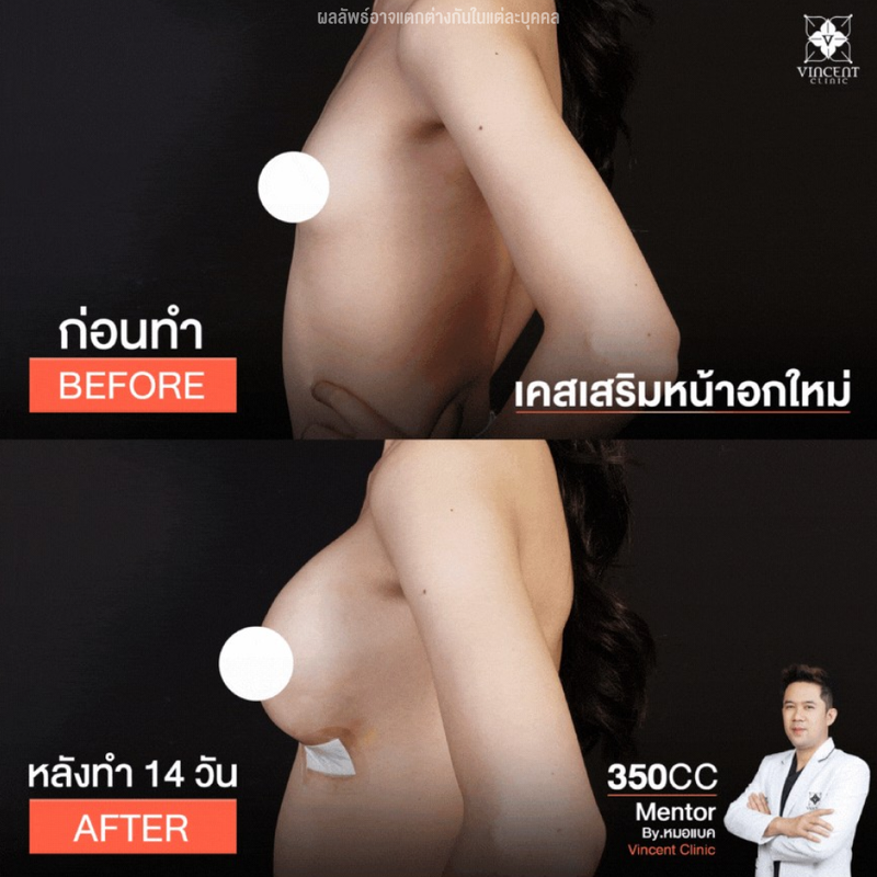 ก่อนและหลังเสริมหน้าอกที่ Vincent Clinic คนที่ 2 โชว์อก