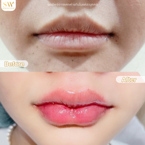 รีวิวฉีดฟิลเลอร์ปากที่ Sowon Clinic รูปที่ 5