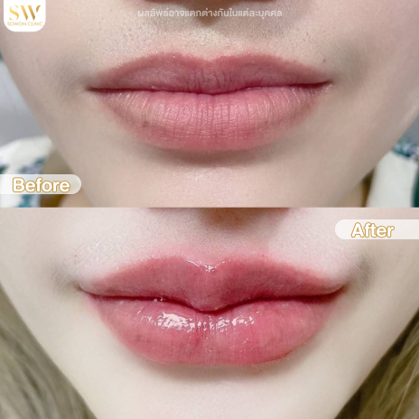 รีวิวฉีดฟิลเลอร์ปากที่ Sowon Clinic รูปที่ 6